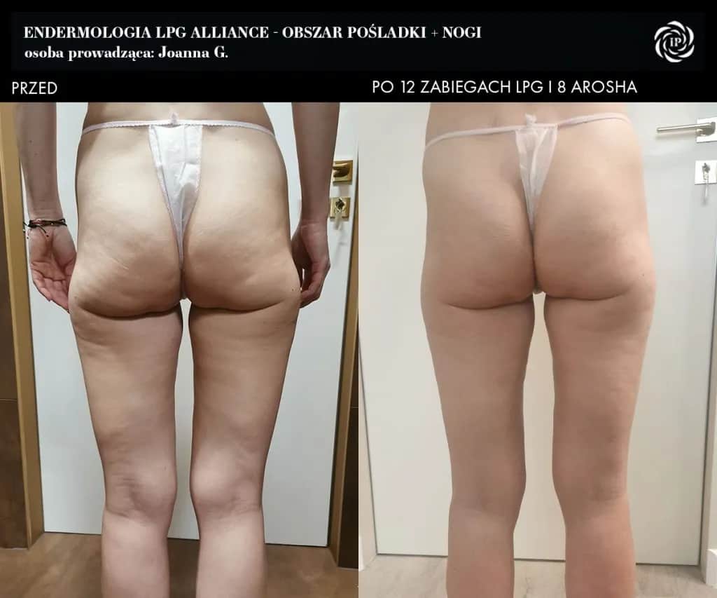 Endermologia: Ile cm stracisz w obwodzie? Mierzalne efekty!
