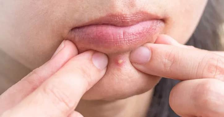 Pryszcz podskórny: Jak go usunąć bezpiecznie i bez blizn?